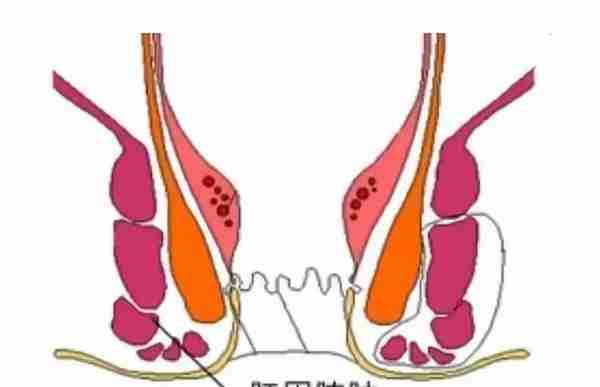 「肛周脓肿」系列之一｜肛周脓肿的是因他而起？