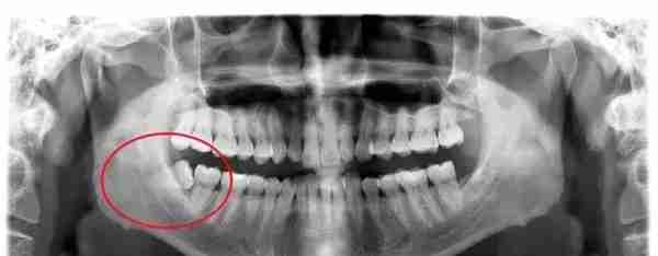 拔智齿价格差别大丨你想知道自己的智齿，拔除需要多少钱吗？